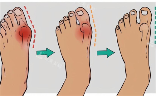 重庆做脚趾拇指矫正多少钱？大拇脚趾外翻做矫正重庆市场价格是单只脚15000元起步的价格！
