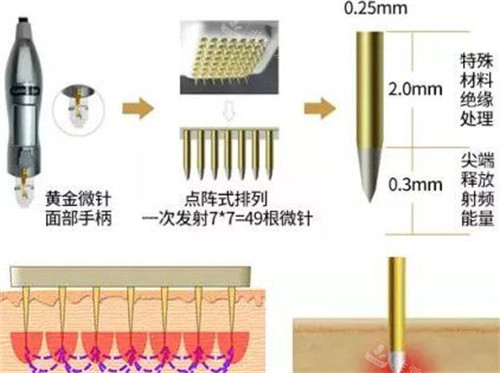 25岁女性适合做的整形项目:黄金微针,M22光子嫩肤,Fotona4d这三个不动刀的微整项目助您塑美!