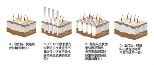 點(diǎn)陣激光治療原理