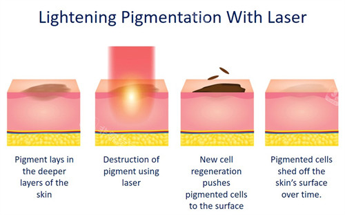 激光祛斑如何改善皮膚斑點(diǎn)