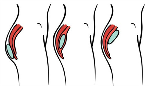 豐臀側(cè)面對比