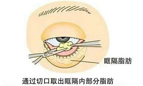 眼底脂肪重排