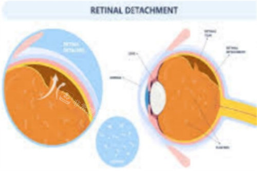 视网膜脱离图示