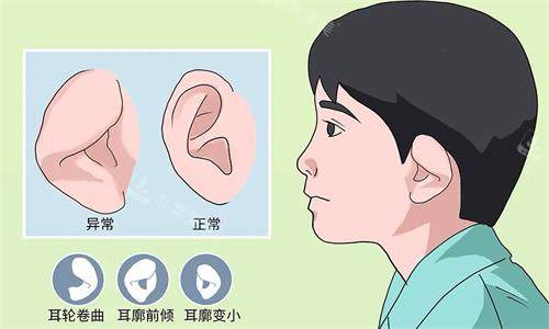 耳朵整形示意圖 耳朵整形示意圖