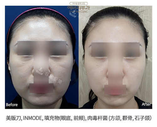 韓國ever皮膚科面部美版超聲前后照片