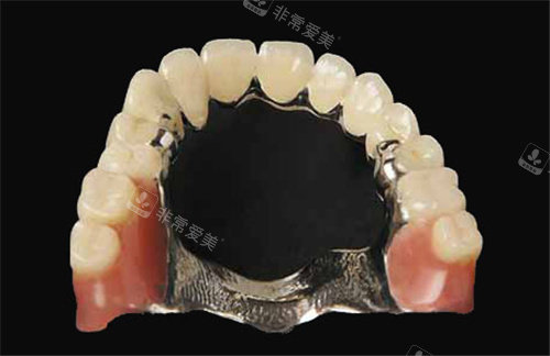 钴铬义齿展示图