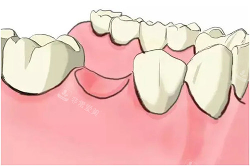 缺牙卡通示意图