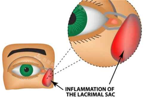泪囊炎症状图解