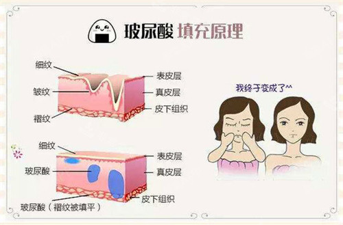 太陽穴凹陷怎么辦?我在韓國皮膚科打了2CC保柔緹改善了太陽穴凹陷,一共花了66萬韓幣