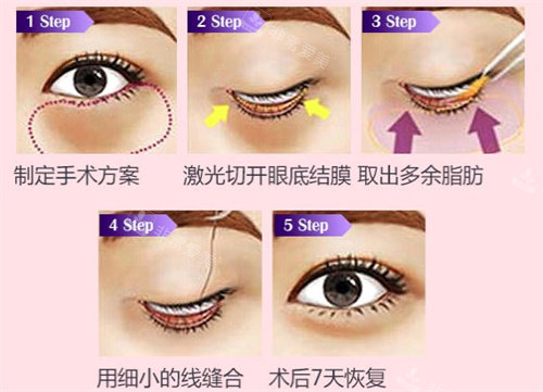 去眼袋手術(shù)過(guò)程 去眼袋手術(shù)過(guò)程