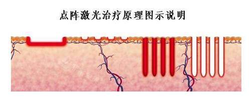 點(diǎn)陣激光的原理 點(diǎn)陣激光的原理