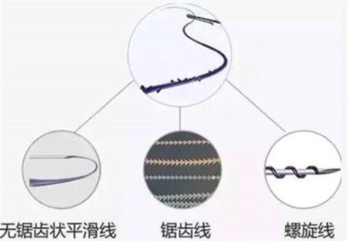 埋線提升不同類(lèi)型的線 埋線提升不同類(lèi)型的線