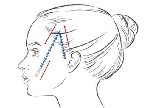 面部埋线卡通示意图