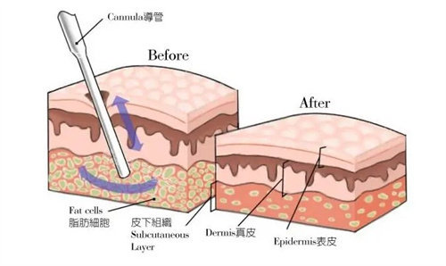 包头抽脂吸脂多少钱一次?腰腹环吸+手臂吸脂去哪家医院更可靠正规?