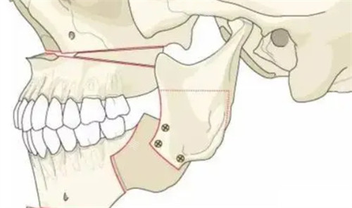 正颌手术后的形状