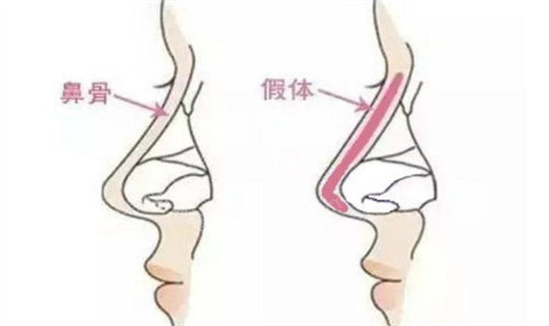 假體前后對比 假體前后對比