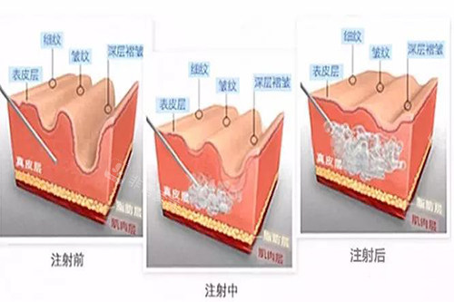 玻尿酸注射皮肤内在过程示意图