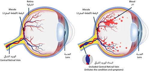 有问题的眼睛和正常眼睛