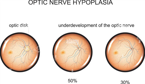 有问题的眼睛和正常眼睛