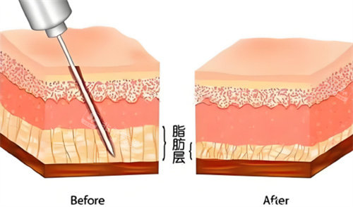 吸脂手术脂肪层对比