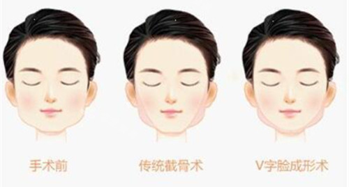 下巴寬大手術(shù)后<span style= 下巴寬大手術(shù)后<span style=