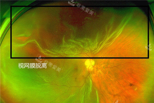 视网膜脱离照片