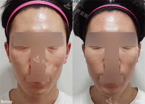 韓國ever皮膚科眼底和臉頰填充前后對比圖 韓國ever皮膚科眼底和臉頰填充前后對比圖