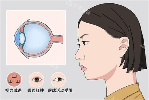 甲亢突眼的危害图解