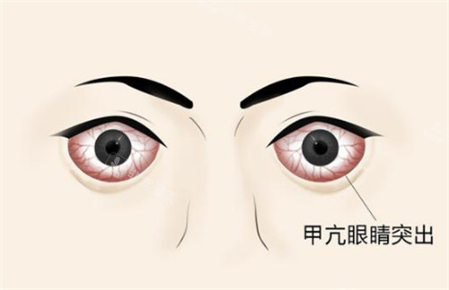 甲亢突眼的样子图片