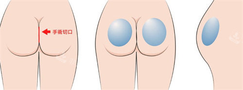 豐臀手術(shù)