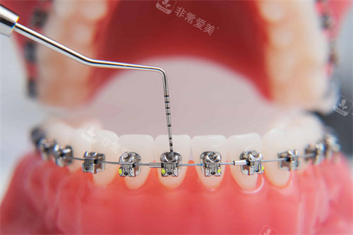 直丝弓矫正器模型