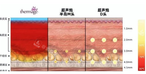 超声炮治疗深度对比