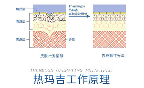 热玛吉工作示意图