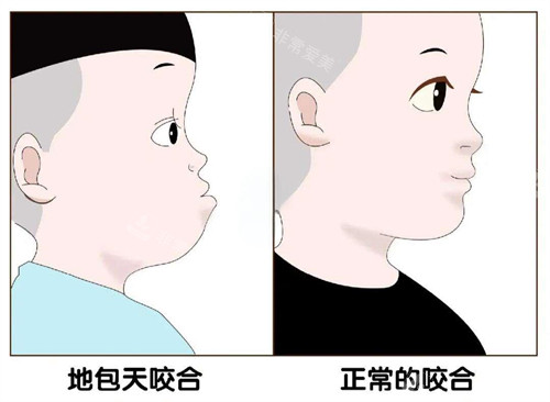 地包天和正常對比圖 地包天和正常對比圖