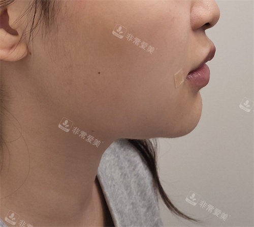 超聲后 超聲后