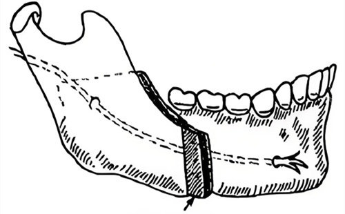 下颌垂直截骨术演示线条图