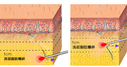 激光溶脂作用皮肤层图