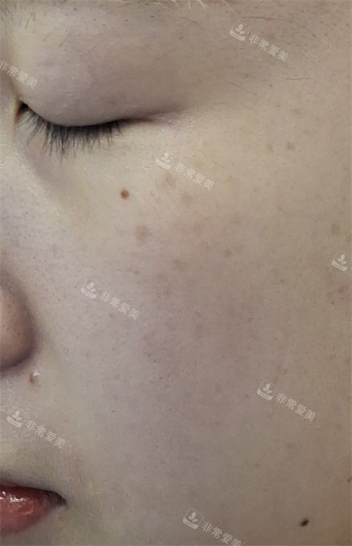 首爾明洞karin皮膚科眼底膠原注射前 首爾明洞karin皮膚科眼底膠原注射前