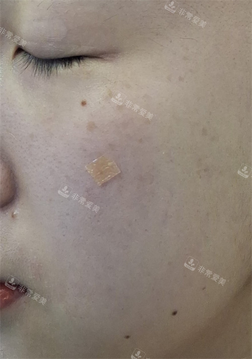 首爾明洞karin皮膚科眼底膠原注射后 首爾明洞karin皮膚科眼底膠原注射后