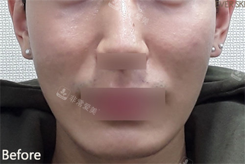 韓國EVER皮膚科填充八字紋術(shù)前圖 韓國EVER皮膚科填充八字紋術(shù)前圖