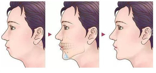 韩国下巴整形手术多少钱，我花30000元在韩国做了下巴整形术后很满意！