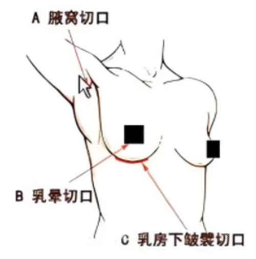 假體隆胸手術(shù)切口位置