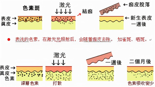 激光祛斑过程