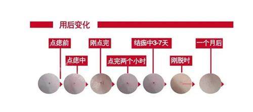 激光去痣后的成效 激光去痣后的成效