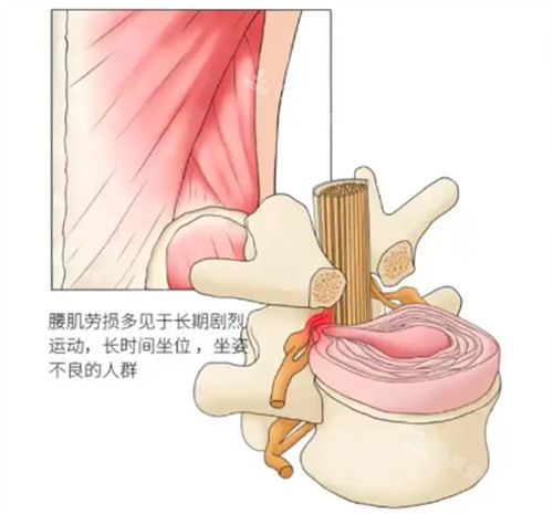 腰肌劳损骨头的变化