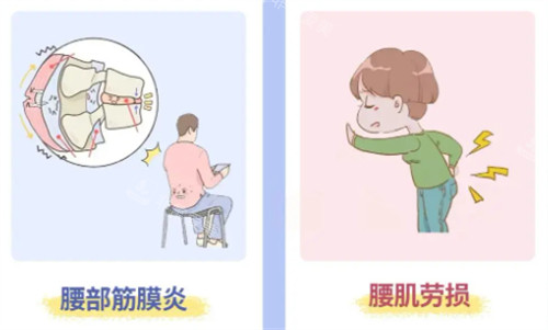 腰肌勞損和筋膜炎的區(qū)別 腰肌勞損和筋膜炎的區(qū)別