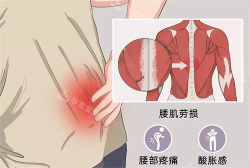 腰肌勞損的癥狀 腰肌勞損的癥狀
