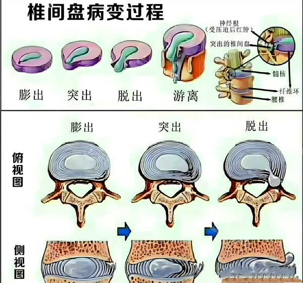 腰椎間盤突出的過程 腰椎間盤突出的過程