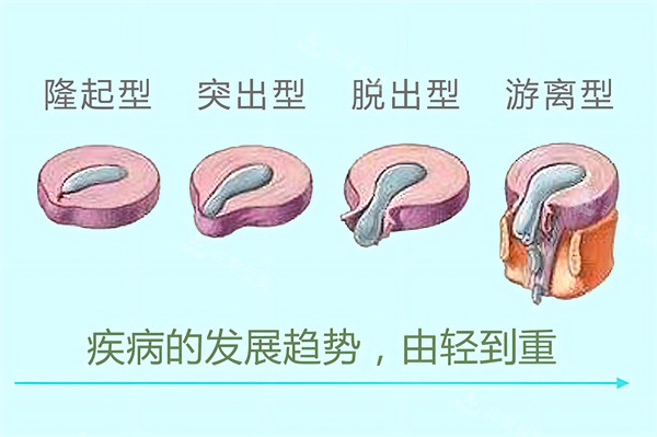 腰椎間盤突出的類型 腰椎間盤突出的類型