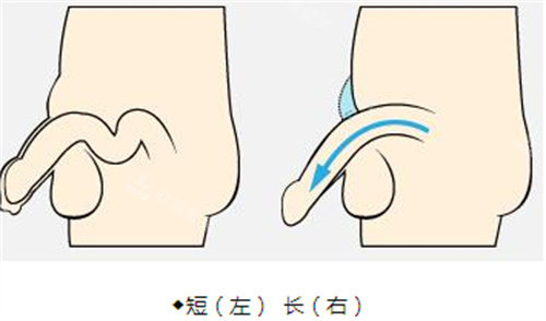 阴茎增长手术前后演示动画图